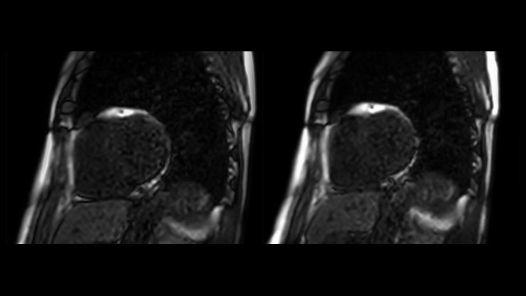 Conventional perfusion versus perfusion with Cardiac Motion Correction