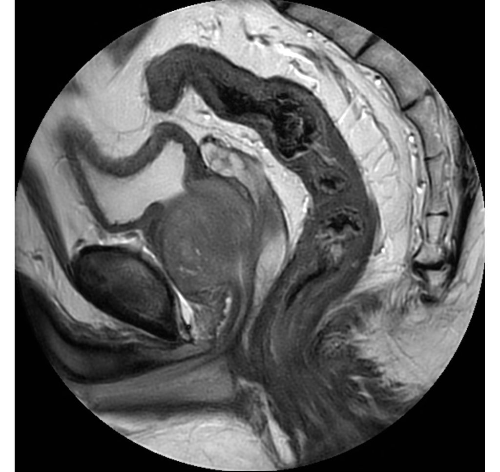 MultiVane XD - Sagittal T2w TSE