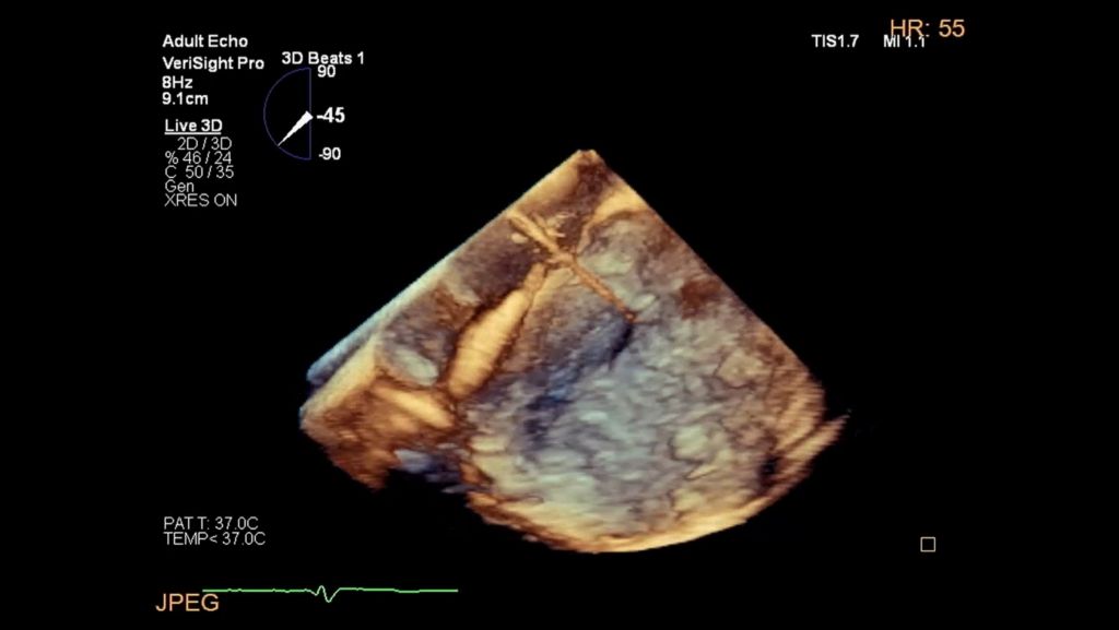 Transseptal puncture in traditional 3D rendering