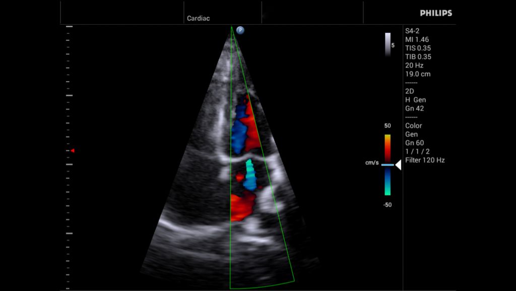 S4-2 Mitral Regurgitation