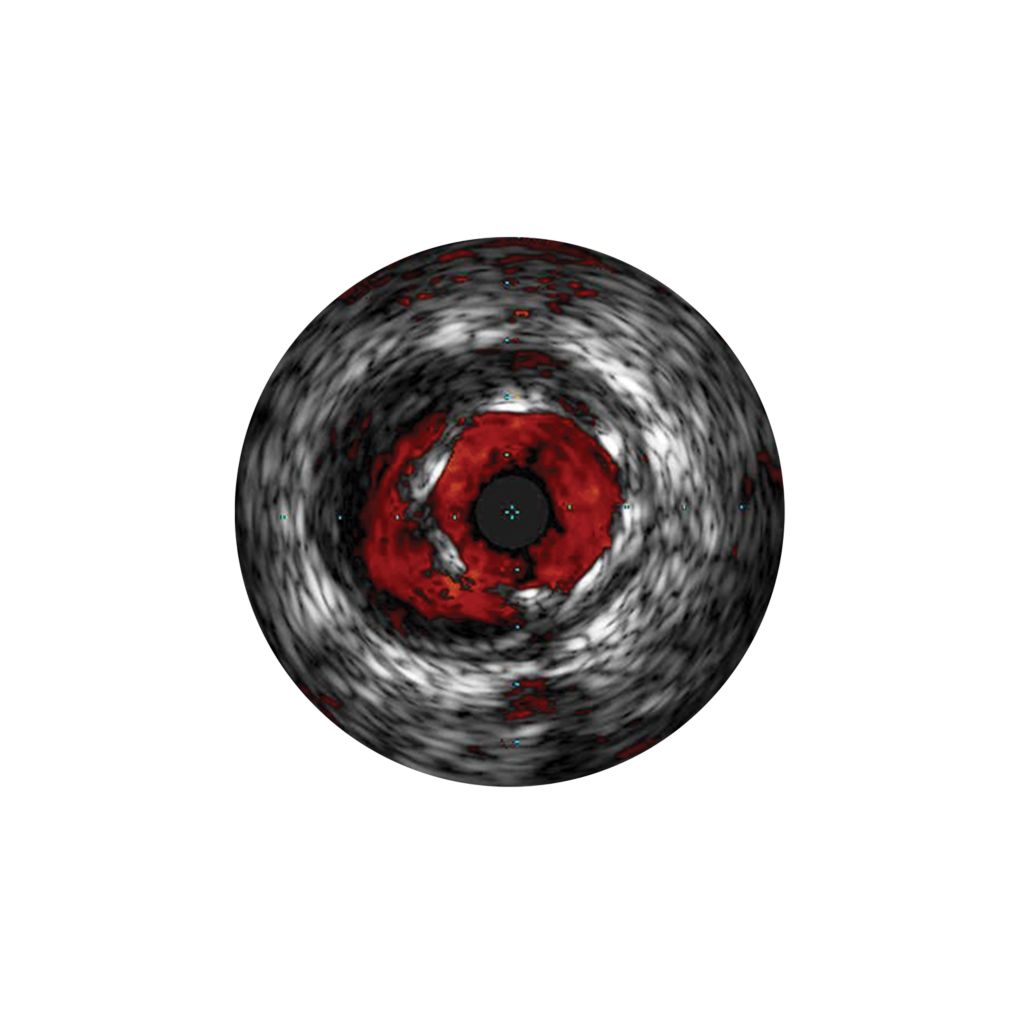 ChromaFlo stent apposition assessment