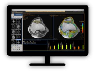 MR Cartilage Assessment Visualize cartilage structures​