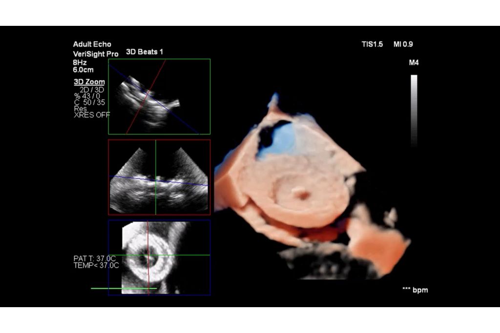 PFO closure using TrueVue and MultiVue
