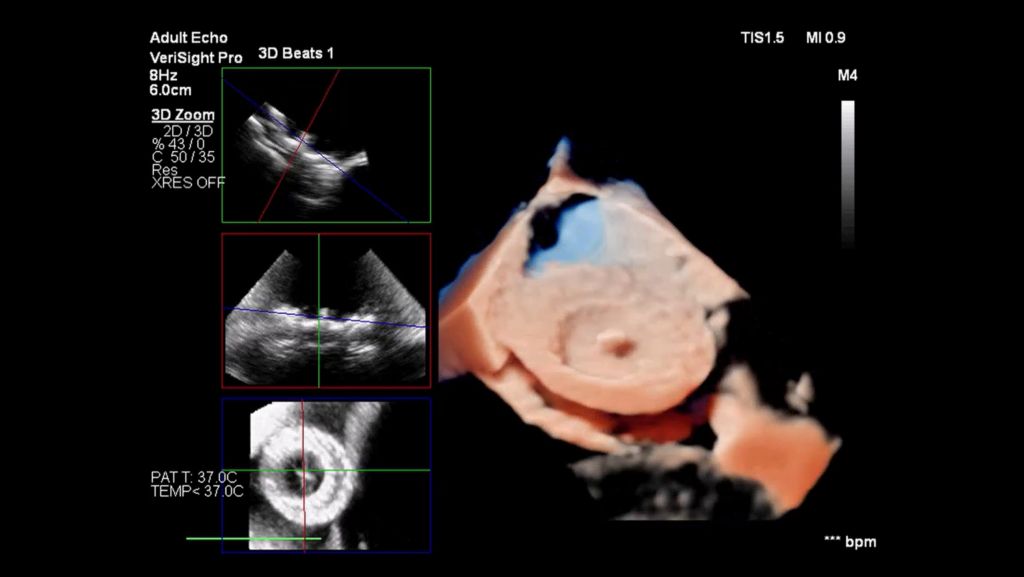 PFO closure using TrueVue and MultiVue