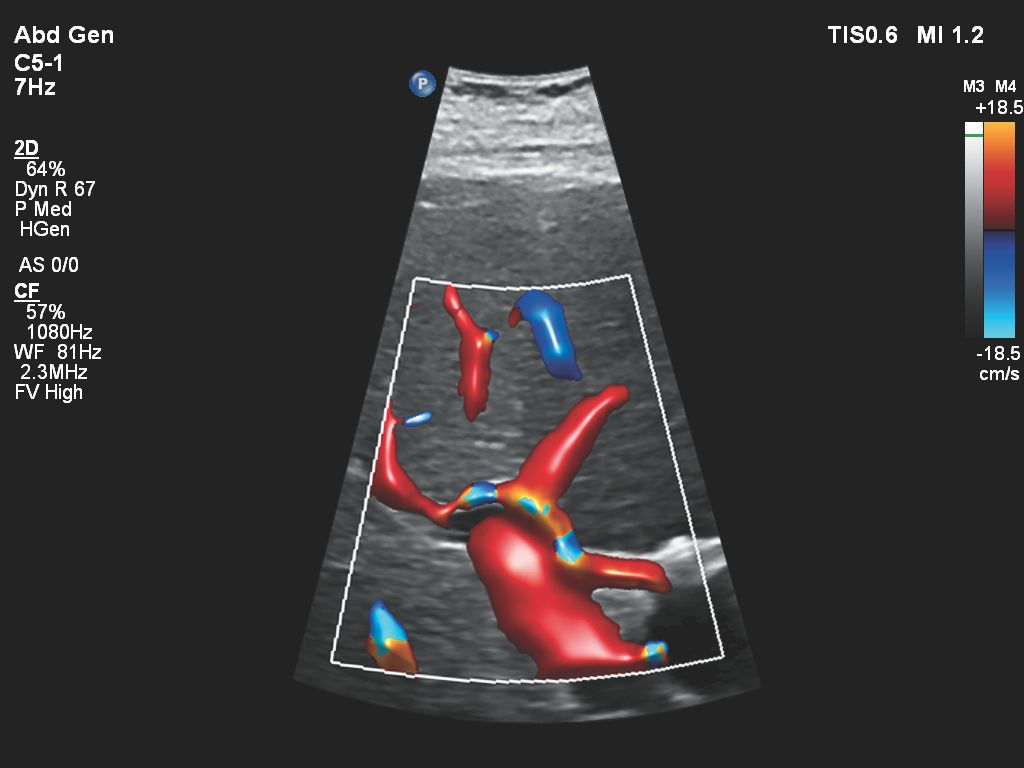 Liver with Portal Vein and Hepatic Artery with Flow Viewer using C5-1 transducer