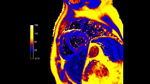 CardiacQuant - T2 map
