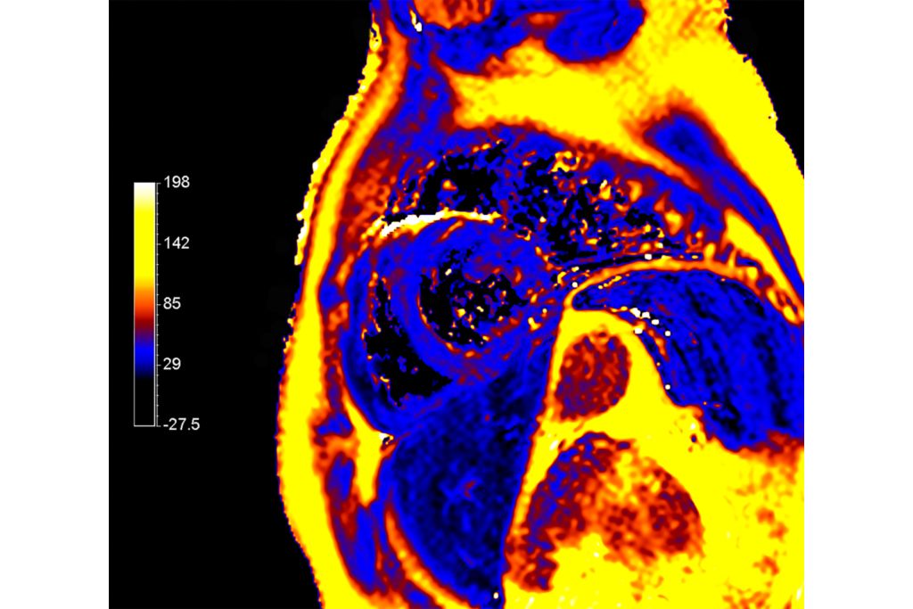 CardiacQuant - T2 map
