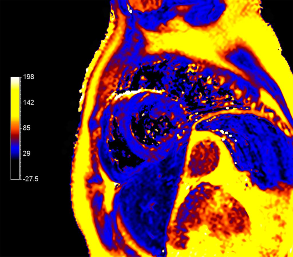 CardiacQuant - T2 map