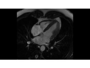 Compressed SENSE - Cardiac MR Clinical Applications