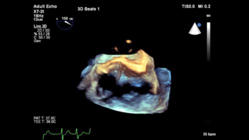 Live 3D TEE CV Ultrasound Imaging