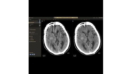 Automatic motion compensation for neuro helical​​