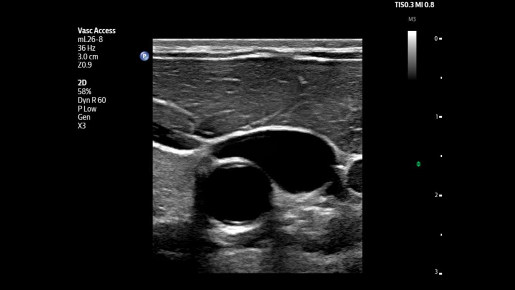 Short axis of jugular vein and carotid artery using mL26-8 transducer.