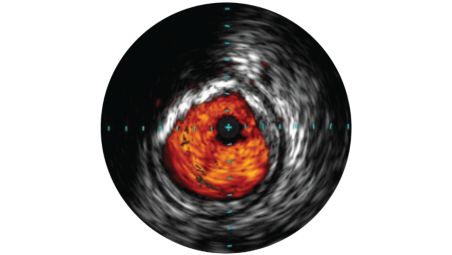 IVUS imaging helps physicians assess disease markers including plaque burden percentage, lesion location and morphology, calcium volume, and the presence of thrombus.