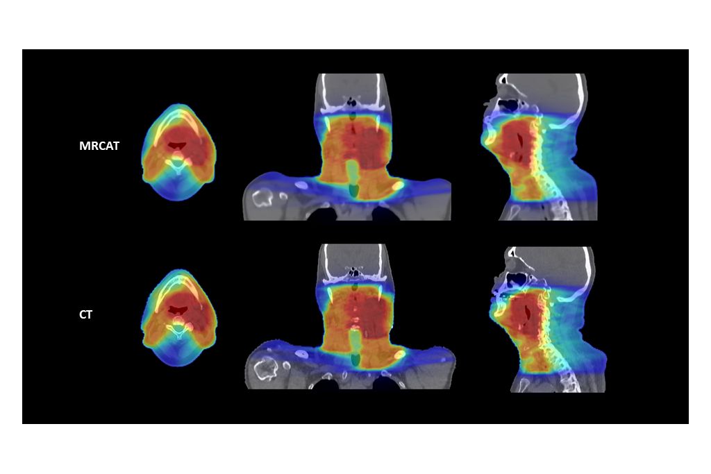 MRCAT-based and CT-based dose plans