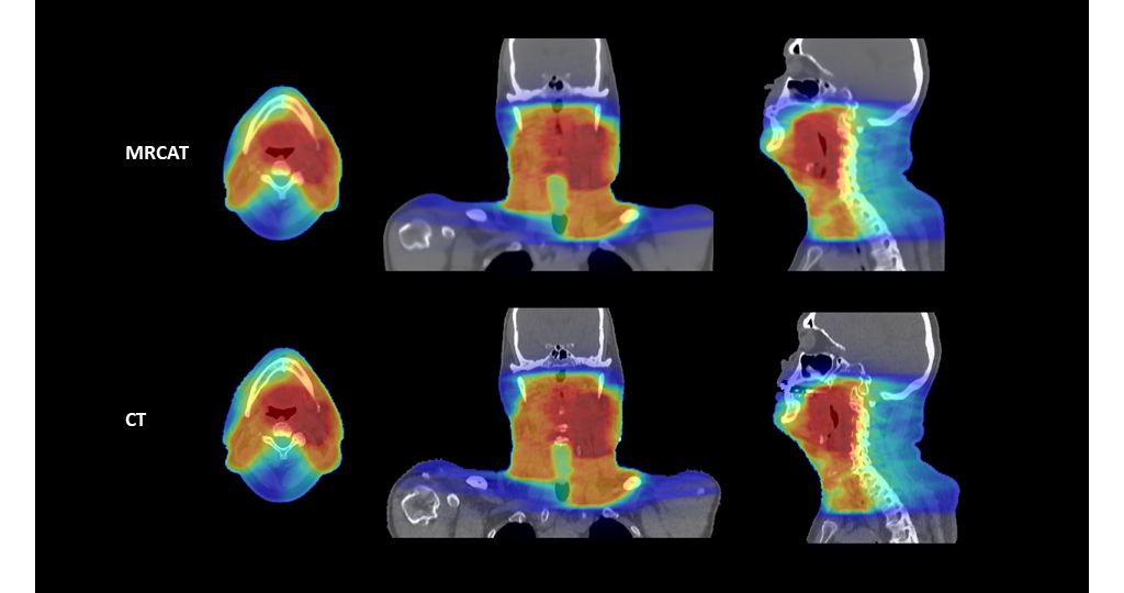 MRCAT-based and CT-based dose plans