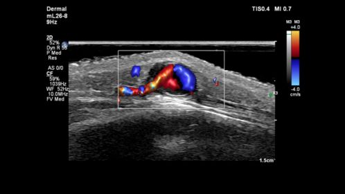 mL26-8 Paired with Flow Viewer on a Pediatric Forehead Lesion