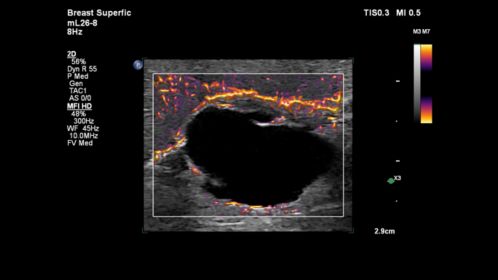 mL26-8 Paired with MFI HD on a Superficial Breast Cyst