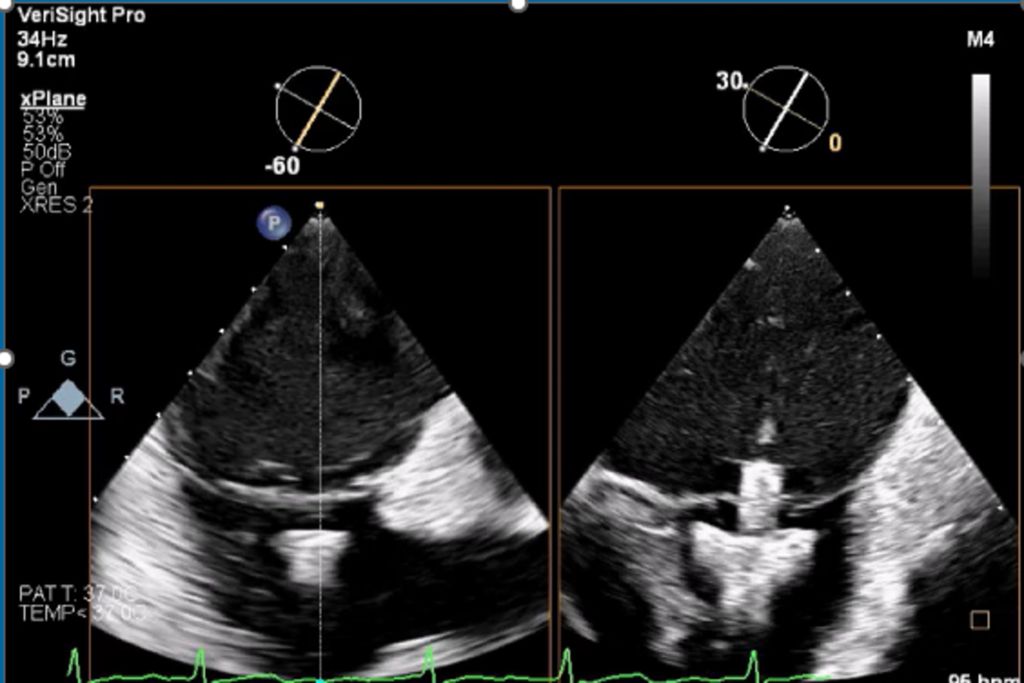 Assessing position and orientation of TriClip device below leaflets using xPlane: 2D imaging mode - Image on file with Philips