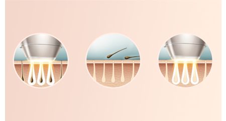 تقنية IPL المتطورة للاستخدام في المنزل، تم تطويرها بالتعاون مع أطباء الأمراض الجلدية