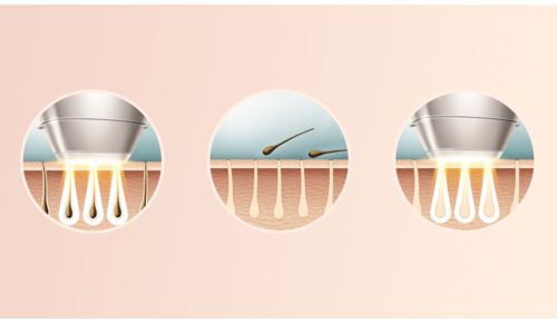 Professionelle IPL-Technologie für zu Hause, mit Dermatologen entwickelt