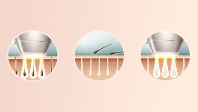 Expert IPL technology at-home, developed with dermatologists