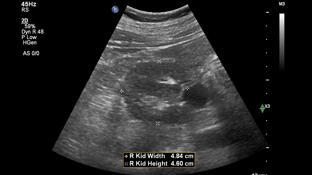 Clinical image using Affiniti and C5-1 transducer showing abdominal renal right kidney width and height with Auto Measure Abdomen 