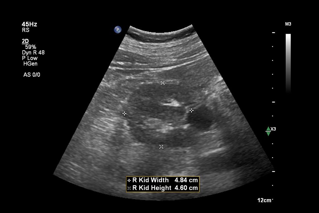 Clinical image using Affiniti and C5-1 transducer showing abdominal renal right kidney width and height with Auto Measure Abdomen 