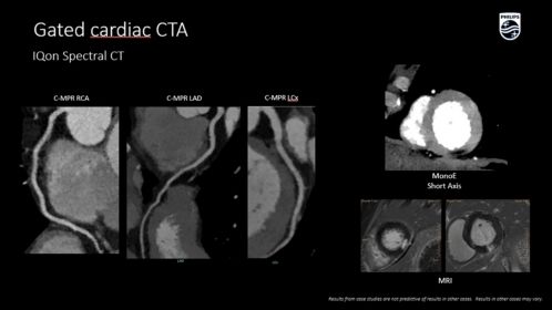 IQon Spectral Gated cardiac CTA