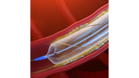 Philips 2200-3515-B AngioSculpt Evo RX PTA scoring Balloon Catheter