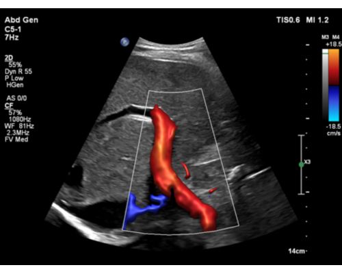 Abd Gen Liver PV FV AS on