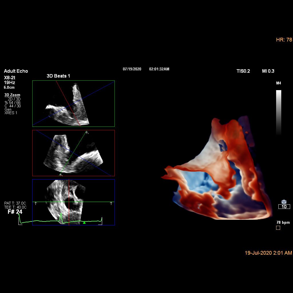 Ultrasound Left Atrial Appendage solution