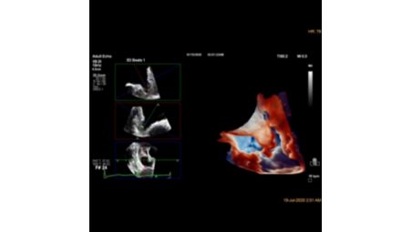 Ultrasound Left Atrial Appendage solution