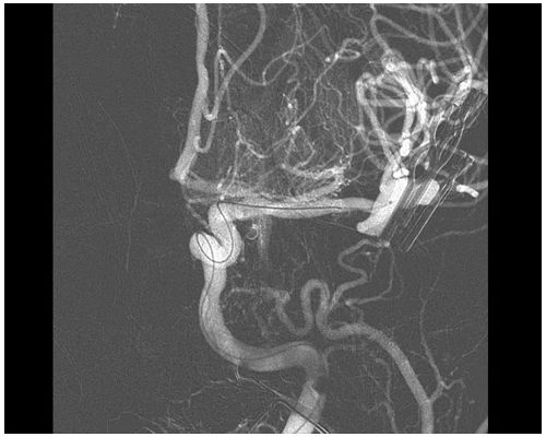 Enhance visualization of vasculature