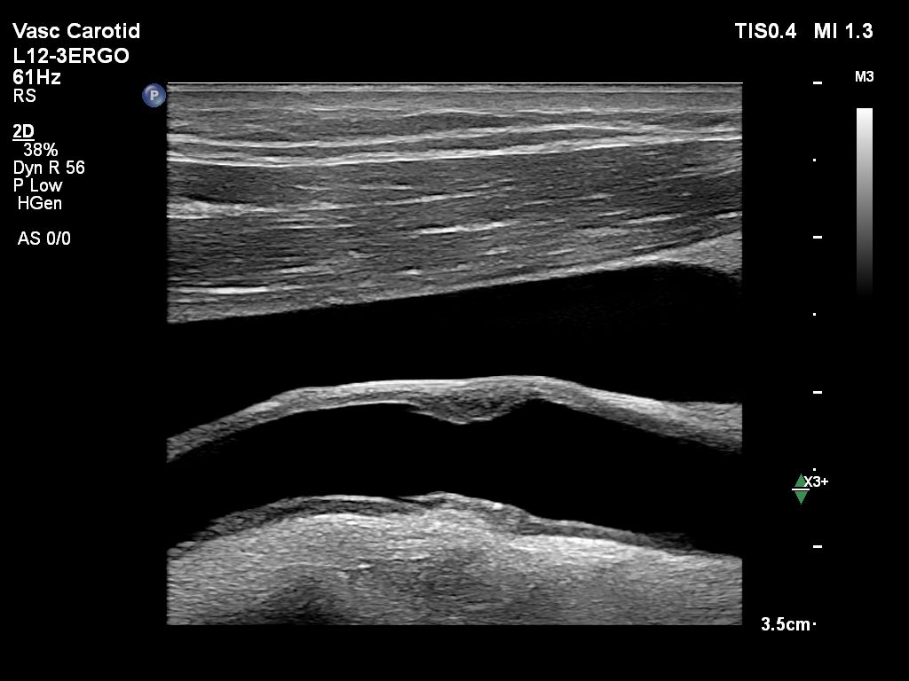 L12-3ERGO Vascular Carotid EPIQ VM14 Plaque 2D