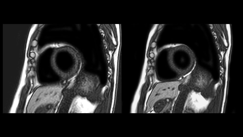 Conventional LGE versus LGE with Cardiac Motion Correction