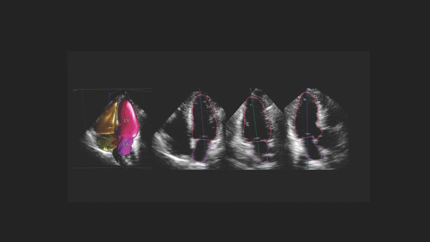 How HeartModel works
