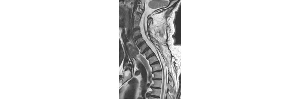 Sagittal T2w TSE - Cervical Spine