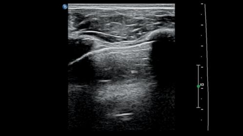 Lung plueral lining