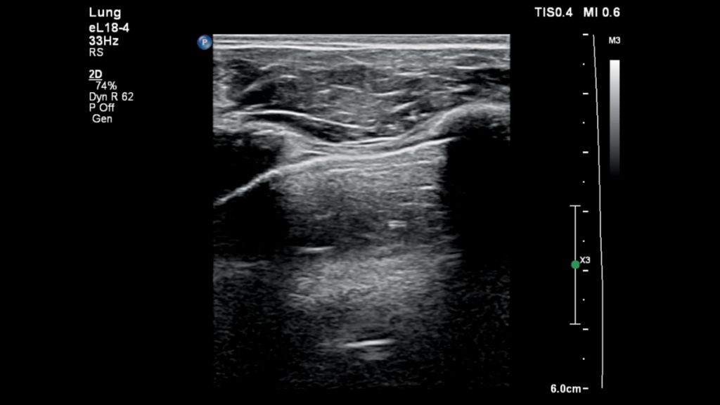 Lung pluera lining image using eL18-4 transducer with Compact 5000 Series