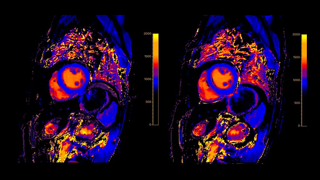 T1 conventional versus T1 Cardiac Motion Correction