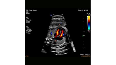 Définit la vascularisation avec un aspect 3D en utilisant à la fois la vitesse et la puissance du signal Doppler pour représenter avec précision la topographie du flux vasculaire