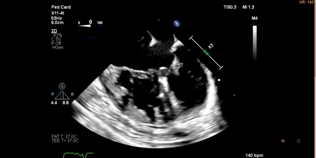 X11-4t mini 3D TEE AV Canal in a Neonate