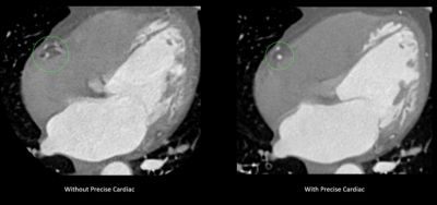 Cardiac CT comparison with and without precise cardiac