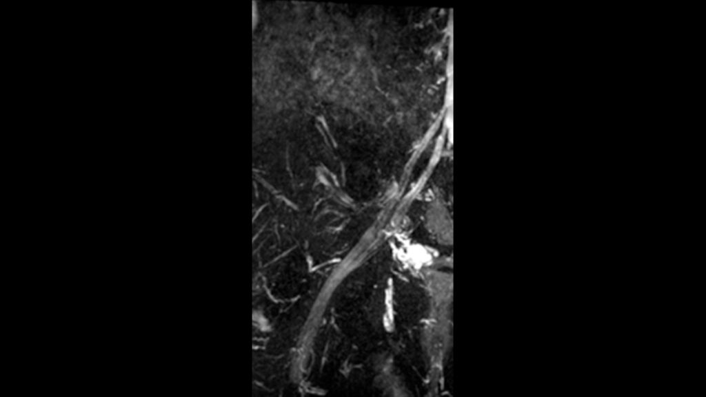3D NerveVIEW (Lumbar Plexus)