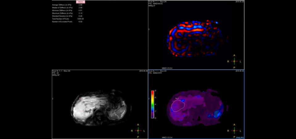 Axial MR Elastography (wave images and stiffness maps in kPa)