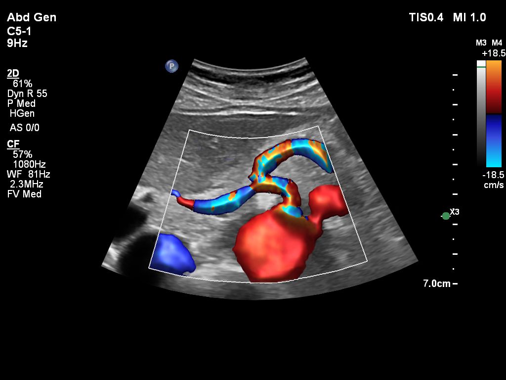 Celiac Axis with Flow Viewer using C5-1 transducer