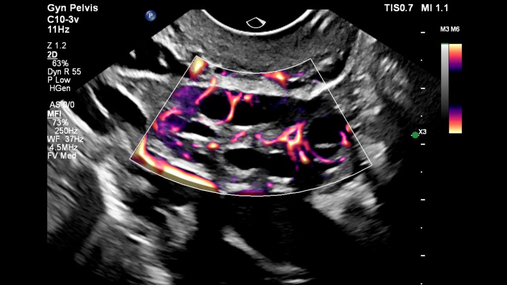 Ovarian blood flow with MFI using C10-3v transducer