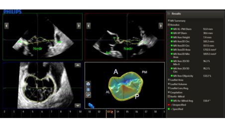 Mitral Valve Navigatorᴬᴵ (MVNᴬᴵ)