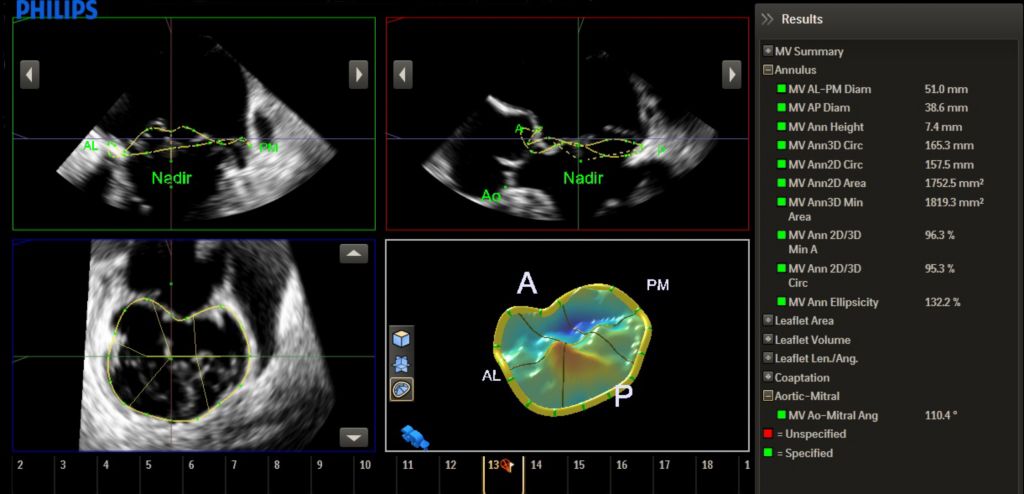 Mitral Valve Navigatorᴬᴵ (MVNᴬᴵ)