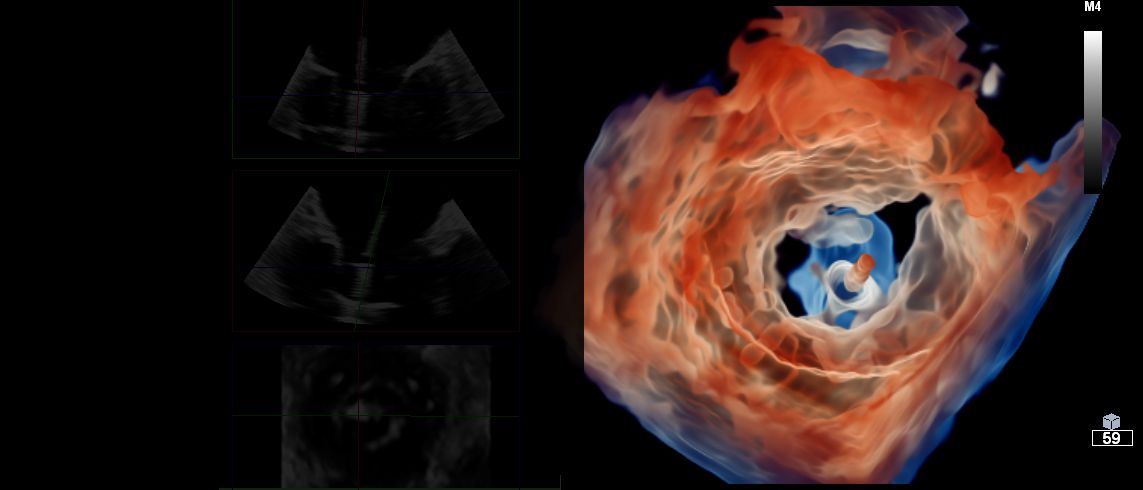 Accelerating Ultrasound Innovation with NVIDIA